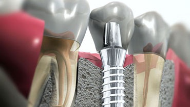 dental implant tile