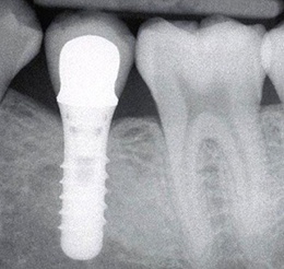 dental implants image